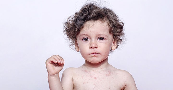 Chickenpox In Children: Symptoms, Treatment And Home Remedies Chickenpox In Children: Symptoms, Treatment And Home Remedies